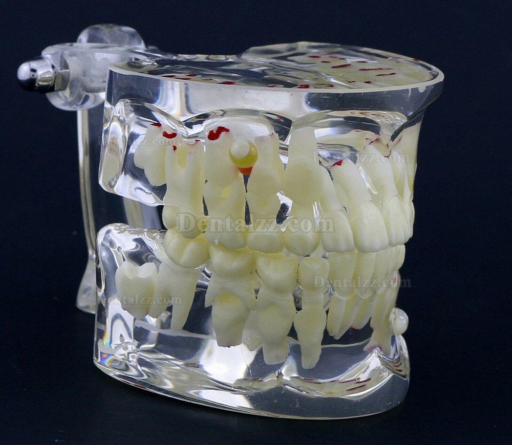 新しい歯科模型 歯列モデル 子供小児病理模型 教学 研究 説明用 4002